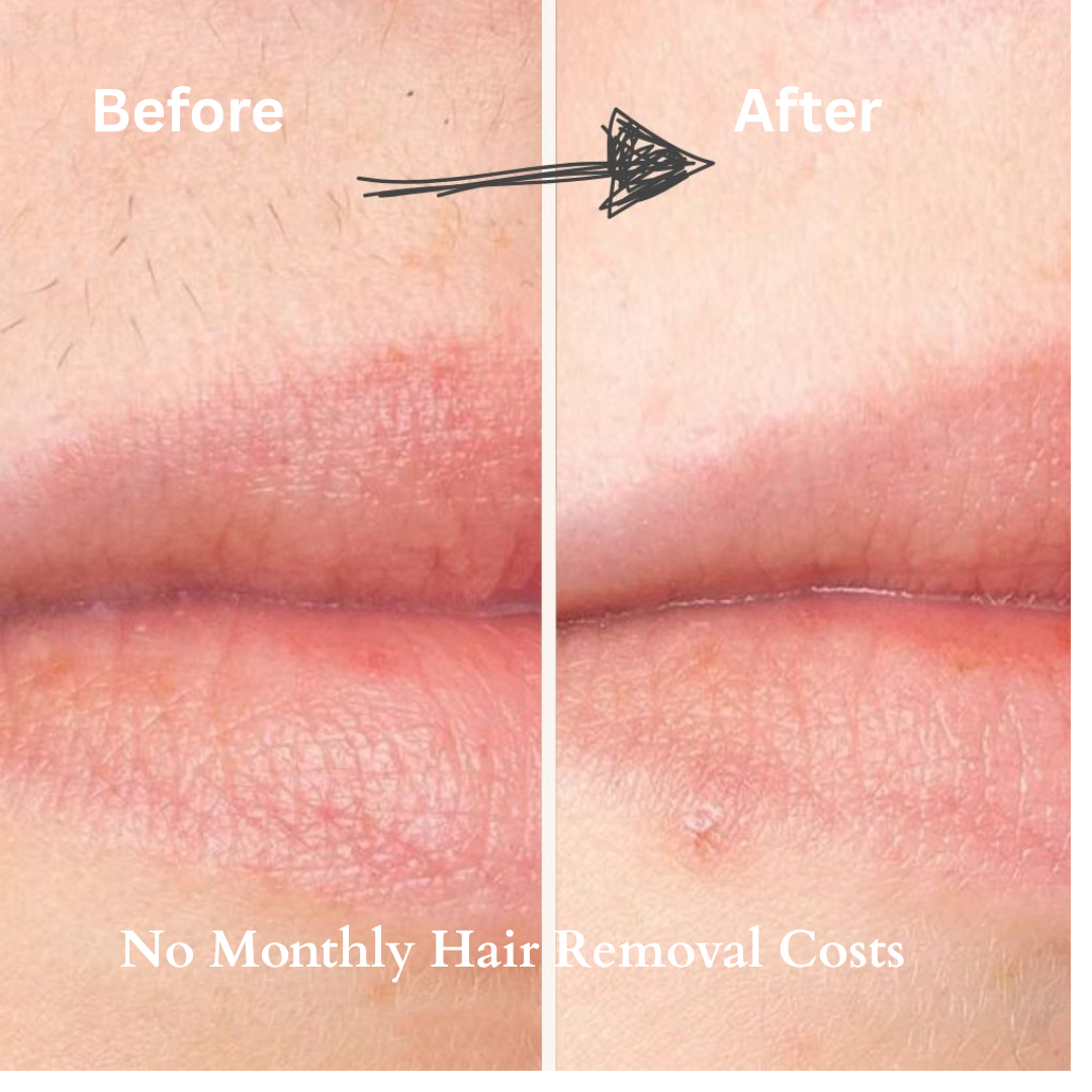 Venaria™ IPL Permanent Hair Remover – Better Than £3,000 Salons